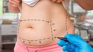 Abdominoplasty 