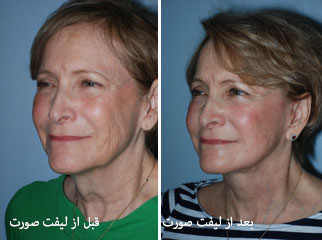 facelift-after-before