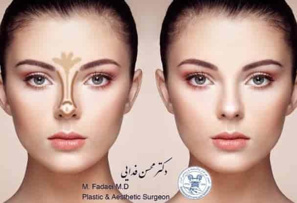 After rhinoplasty surgery