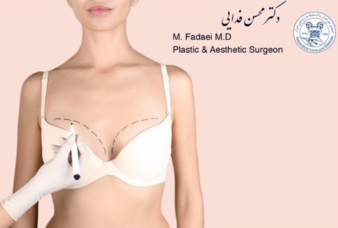 UPBRA TRY-ON, Breast Augmentation Q&A