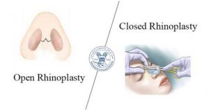 Open Rhinoplasty