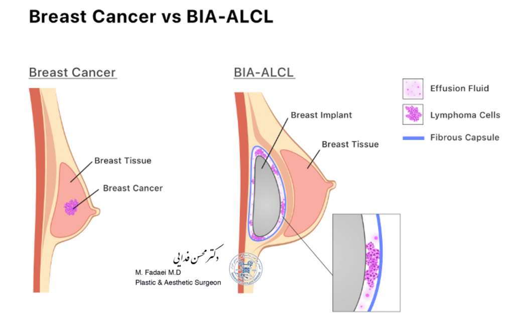 Breast Implant and BIA-ALCL- Dr.Mohsen Fadaei-Breast Implant