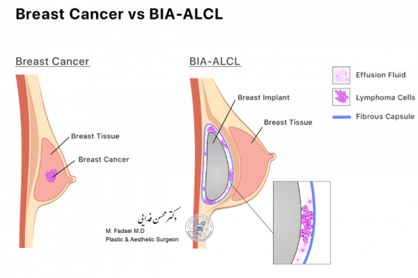 Breast Cancer vs BIA-ALCL