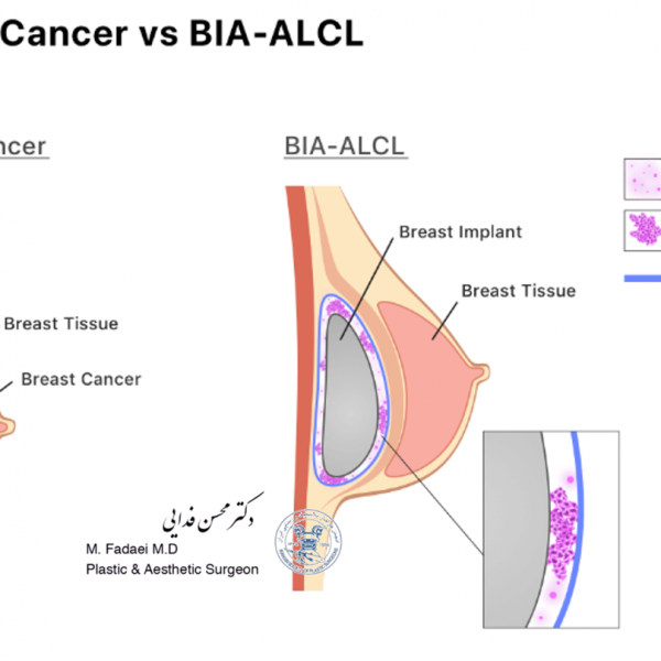 Breast Cancer vs BIA-ALCL