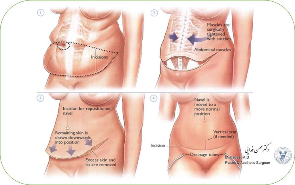 abdominoplasty surgery - Dr.Mohsen Fadaei - Tummy Tuck