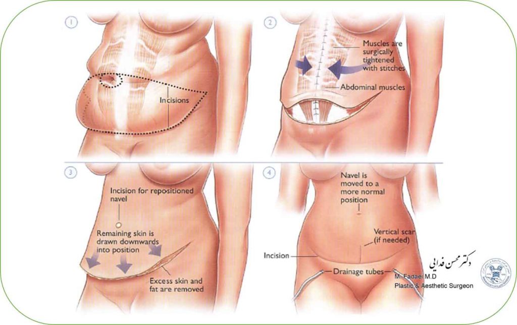 Abdominoplasty (Tummy Tuck) Surgery