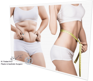 abdominoplasty or Liposuction