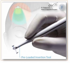 اندوتاین لیفت پیشانی - Answers to questions about brow lift