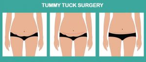 full abdominoplasty and mini abdominoplasty (Tummy tuck)