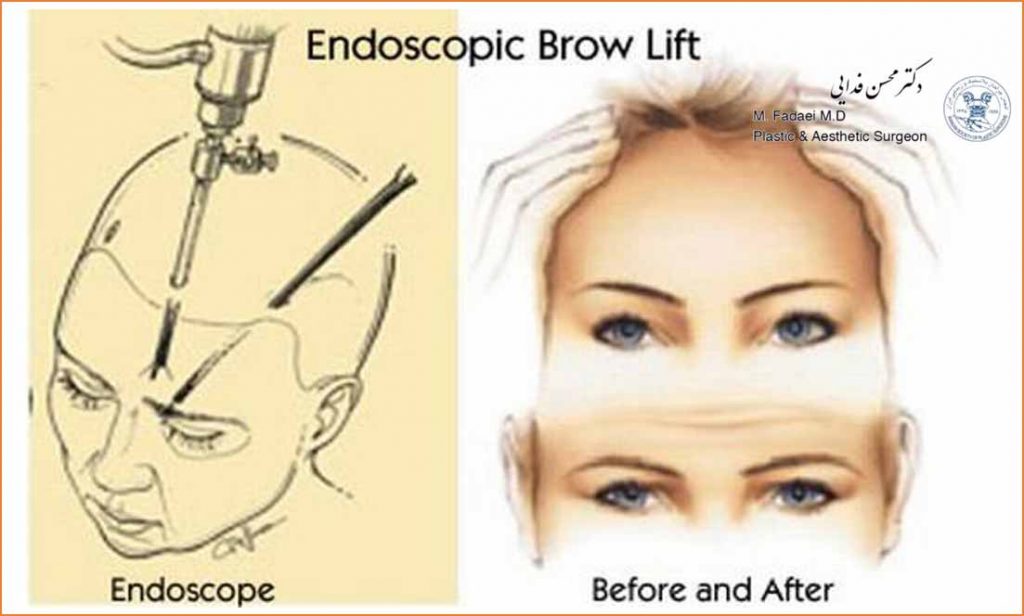 brow lift and forehead lift Dr.Mohsen Fadaei brow lift forehead lift