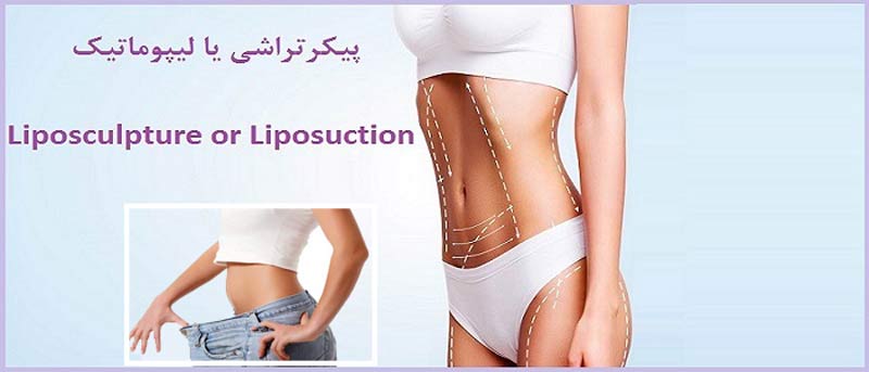 Liposculpture or Lipomatic