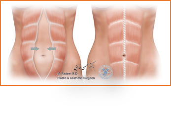 ابدومینوپلاستی - تام تاک