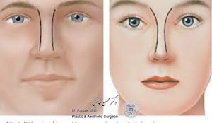 جراحی بینی مردان