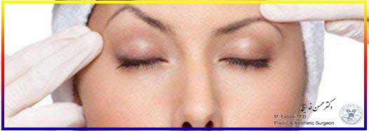 لیفت ابرو - Answers to questions about brow lift