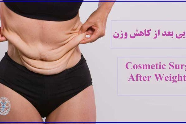 جراحی زیبایی بعد از کاهش وزن - Cosmetic surgery after weight loss