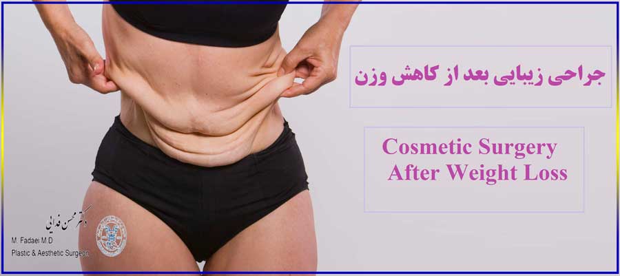 جراحی زیبایی بعد از کاهش وزن - Cosmetic surgery after weight loss