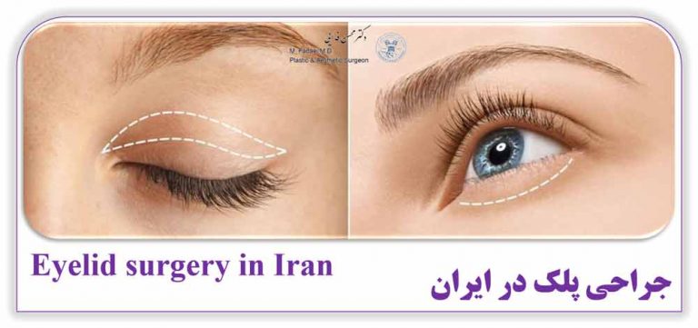 جراحی پلک در ایران - Eyelid surgery in Iran