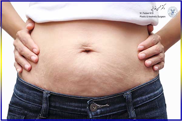 جراحی لیپکتومی ، تامی تاک ، ابدومینوپلاستی - Lipectomy , Tummy Tuck or abdominoplasty