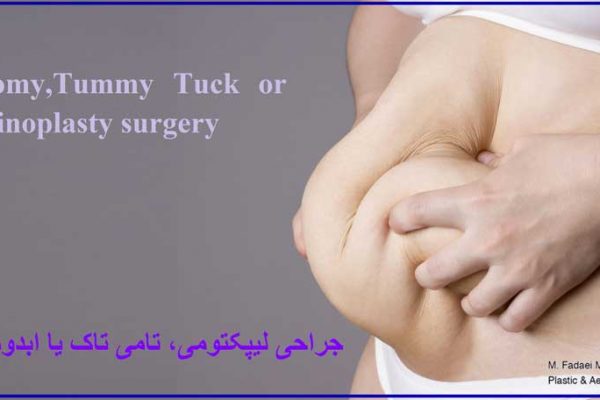 لیپکتومی ، تامی تاک ، ابدومینوپلاستی - Lipectomy , Tummy Tuck or abdominoplasty