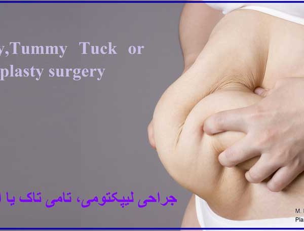لیپکتومی ، تامی تاک ، ابدومینوپلاستی - Lipectomy , Tummy Tuck or abdominoplasty