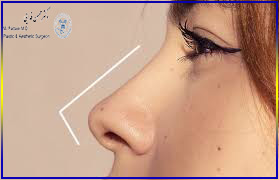 توصیه های مفید برای بیماران بعد از انجام جراحی بینی
