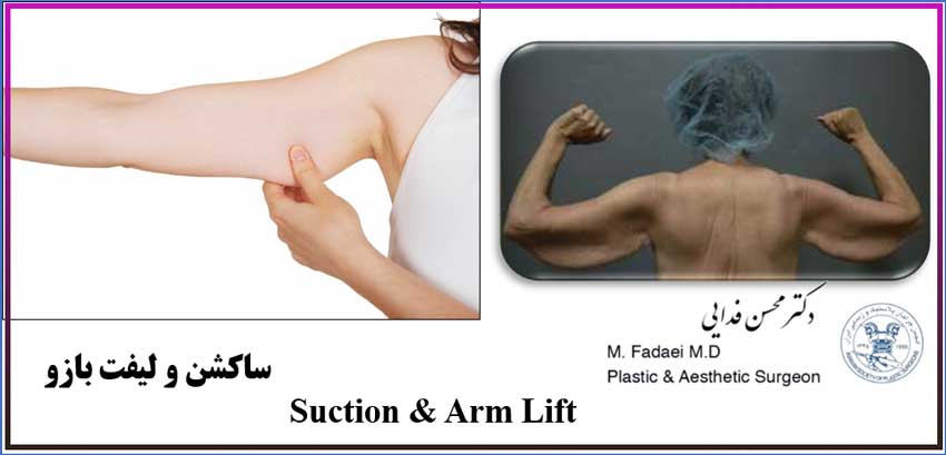 ساکشن و لیفت بازو - Suction and arm lift surgery