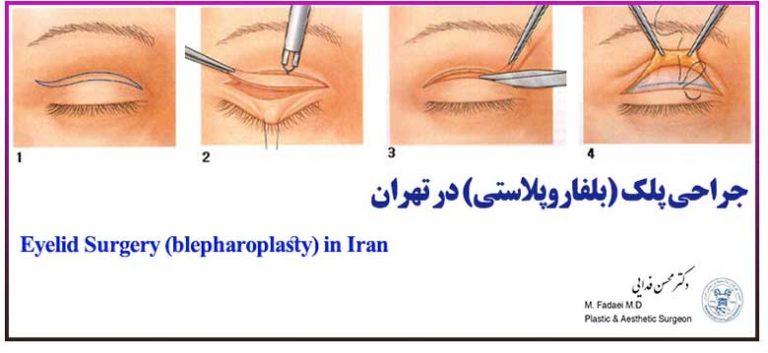 جراحی پلک (بلفاروپلاستی) - Eyelid Surgery (Blepharoplasty)
