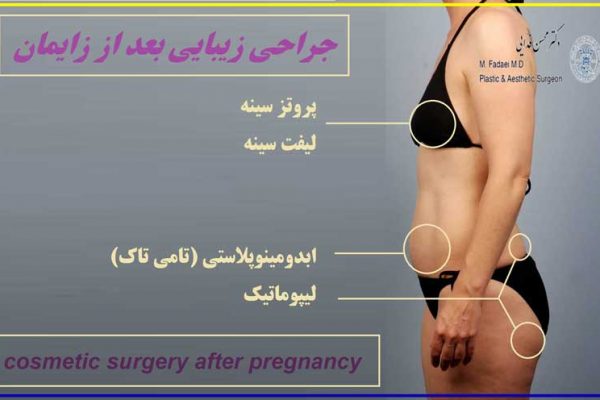 جراحی زیبایی بعد از زایمان - cosmetic surgery after pregnancy - جراحة التجمیل بعد الولادة