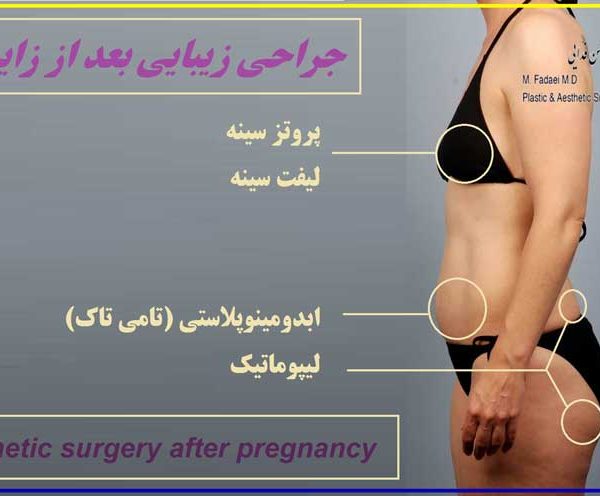 جراحی زیبایی بعد از زایمان - cosmetic surgery after pregnancy - جراحة التجمیل بعد الولادة