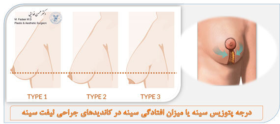 افتادگی سینه (پتوز سینه)