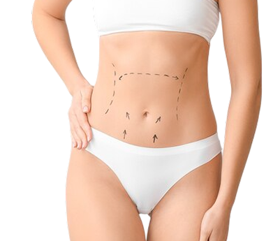 آبدومینوپلاستی