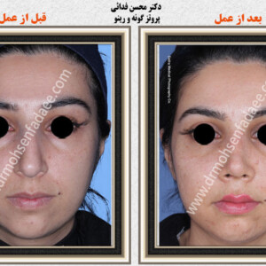 پروتز های صورت و گونه پروتز های صورت و گونه