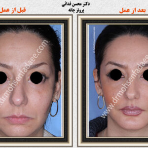 پروتز های صورت پروتز های صورت
