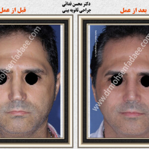 جراحی بینی جراحی بینی