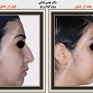 پروتز های صورت و گونه پروتز های صورت و گونه