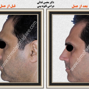 جراحی بینی جراحی بینی