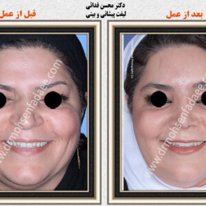 لیفت صورت لیفت صورت