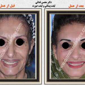 لیفت صورت لیفت صورت