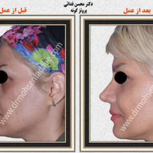 پروتز های صورت پروتز های صورت