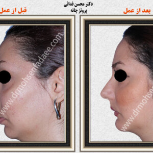 پروتز های صورت پروتز های صورت