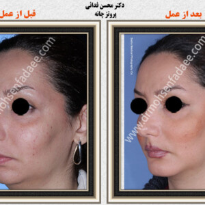 پروتز های صورت پروتز های صورت