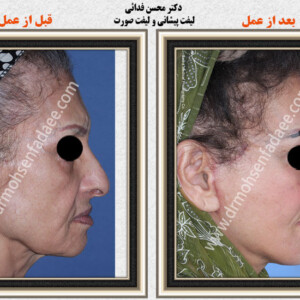 لیفت صورت لیفت صورت