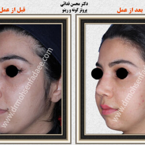 پروتز های صورت و گونه پروتز های صورت و گونه