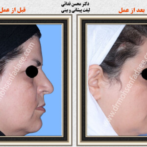 لیفت صورت لیفت صورت