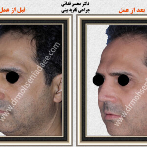 جراحی بینی جراحی بینی
