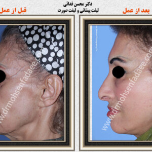 لیفت صورت لیفت صورت