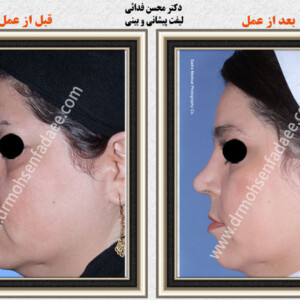 جراحی بینی استخوانی جراحی بینی استخوانی