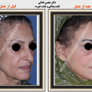 لیفت صورت لیفت صورت