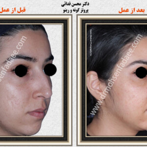 پروتز های صورت و گونه پروتز های صورت و گونه