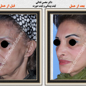 لیفت صورت لیفت صورت